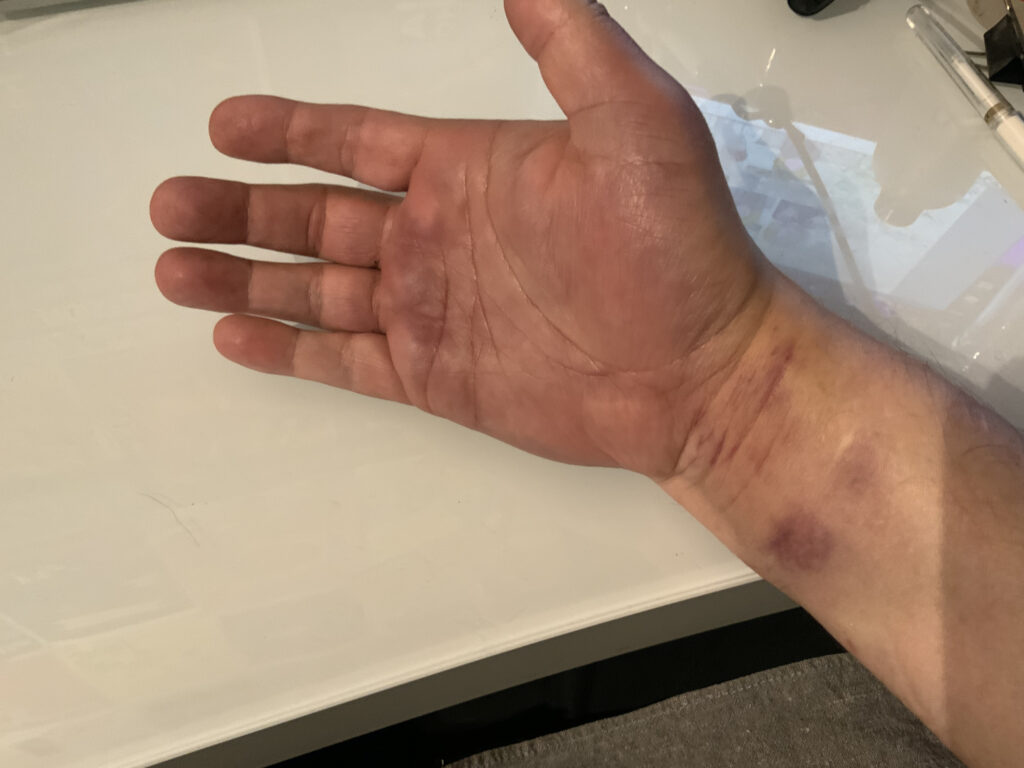 241112 - right hand fucked up after falling off unicycle